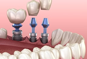 What are Dental Implants? Types, Procedures, And More