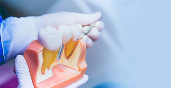 Types of Tooth Replacement Methods: Guide to Your Options