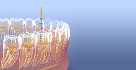 Difference Between Single-visit or Multiple-visit Root Canal Treatment