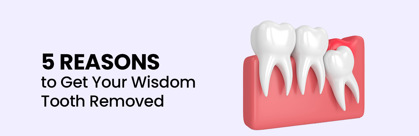 5 reasons to get your wisdom tooth removed