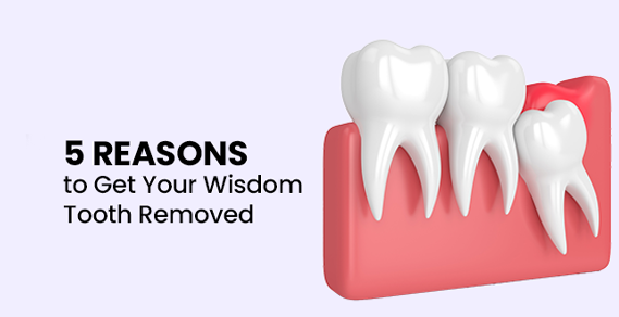5 Reasons to Get Your Wisdom Tooth Removed