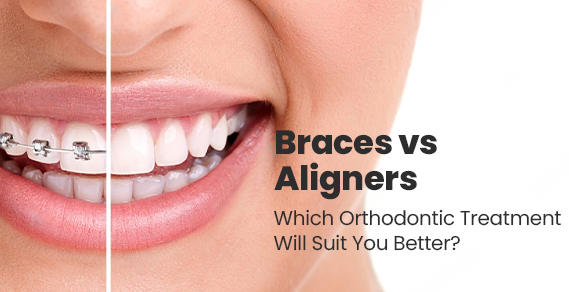 Braces vs Aligners – Which Orthodontic Treatment Will Suit You Better?