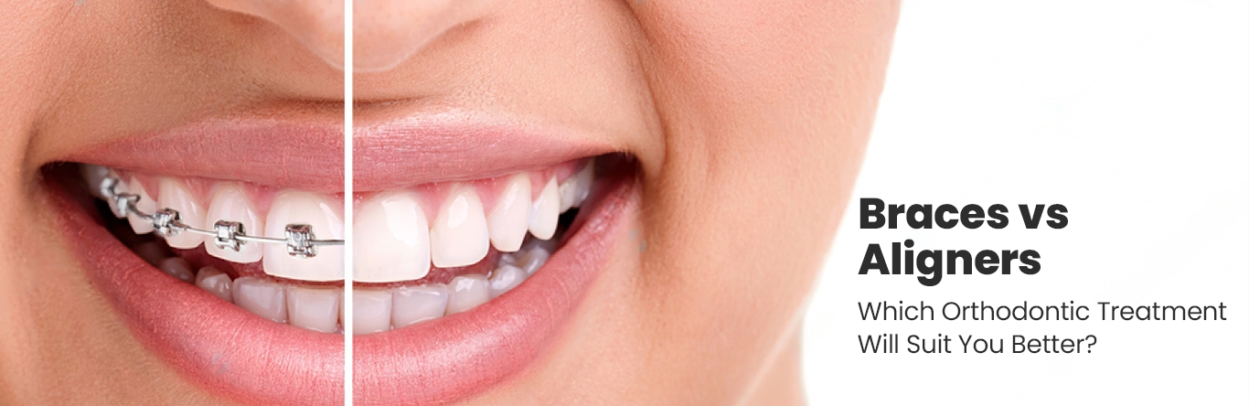 braces vs aligners