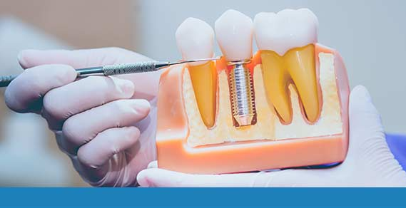 The Ins and Outs of Wisdom Tooth Root Canal Procedures