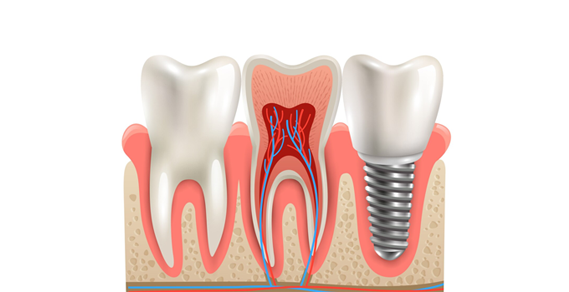 Unlocking the Long Term Benefits of Dental Implants: A Smile Worth Investing In