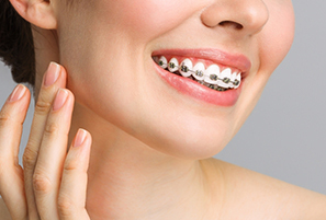 All About Different Types of Braces