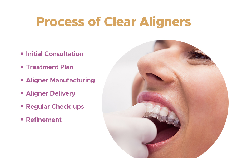 process of clear aligners