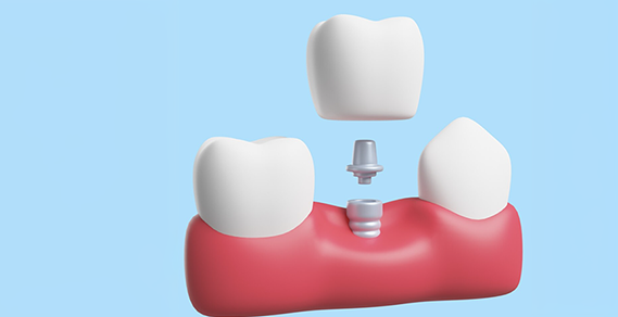 Discovering Numerous Benefits Dental Implants Comprehensive Overview