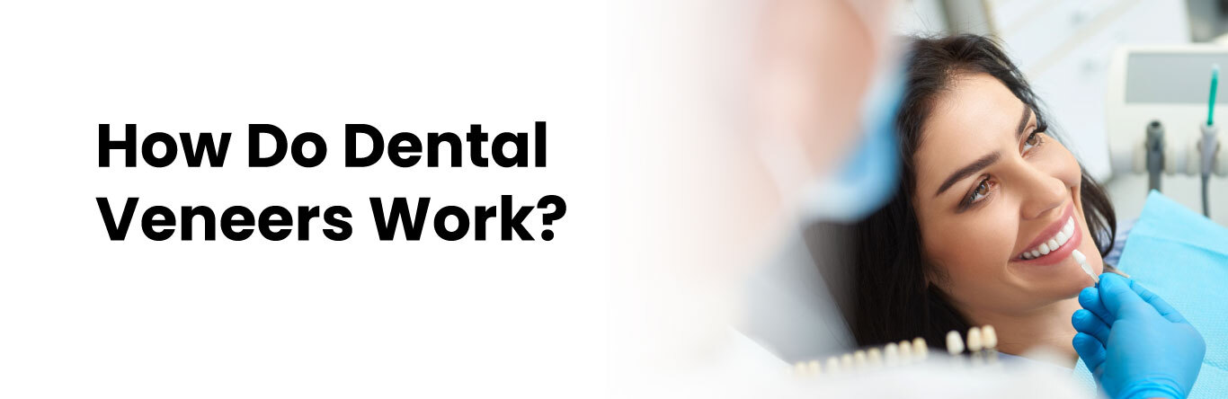 how do dental veneers work