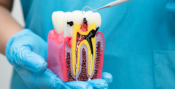 Advantages of Laser Assisted Root Canal Treatment